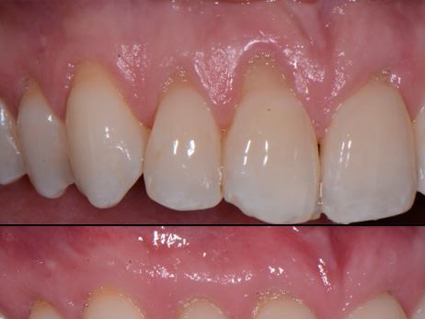 Close-up dental view of upper front teeth showing gum tissue and tooth restoration work.