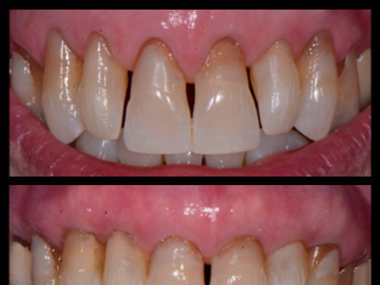 Before and after dental treatment showing tooth restoration and gum health improvement in periodontal care.
