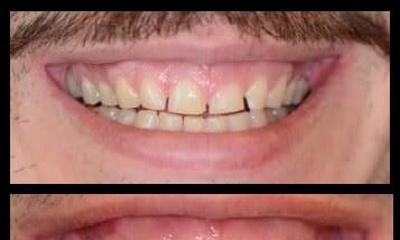 Before and after dental treatment showing improved gum health and tooth appearance.