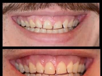 Before and after dental treatment showing improved gum health and tooth appearance following periodontal care.
