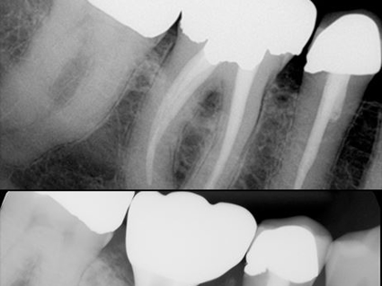 Dental X-rays showing tooth structure and bone loss related to periodontal disease progression.
