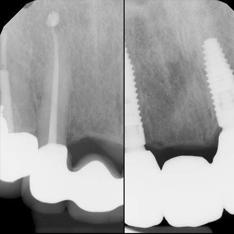 Dental X-rays showing tooth and bone structure with periodontal disease progression comparison.