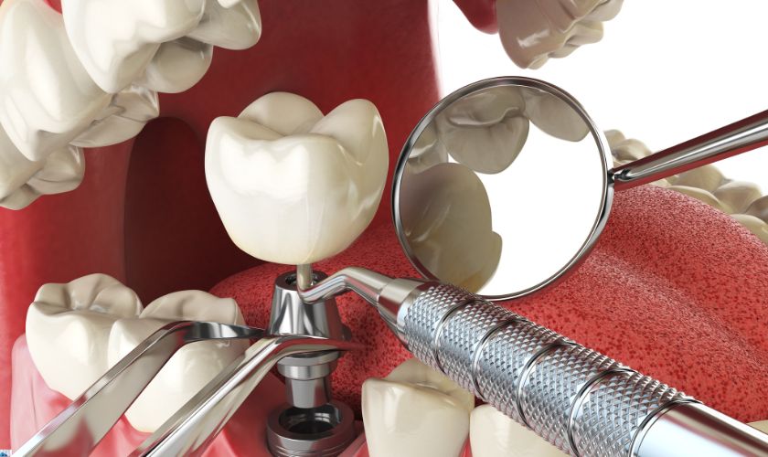 dental implants tigard | cosmetic dentist tigard