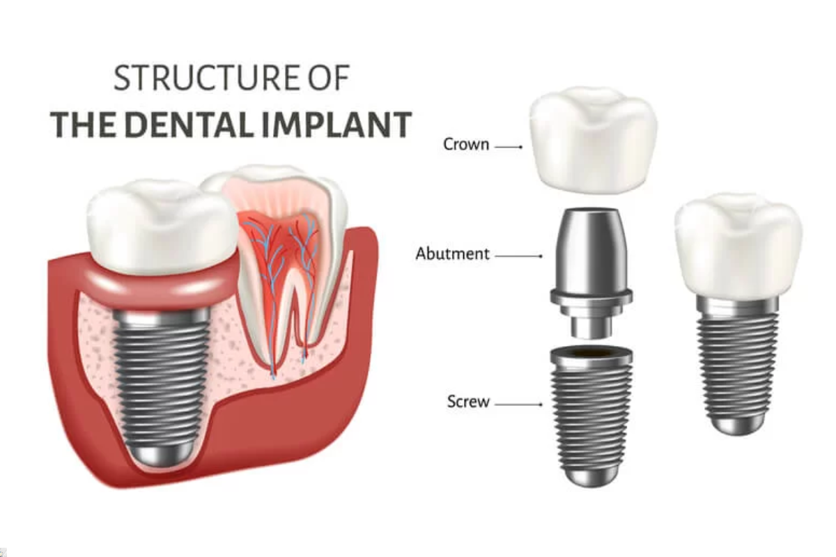 Dental Implants Abutments: Procedure and Aftercare