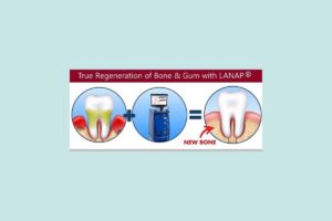 Effectiveness of LANAP