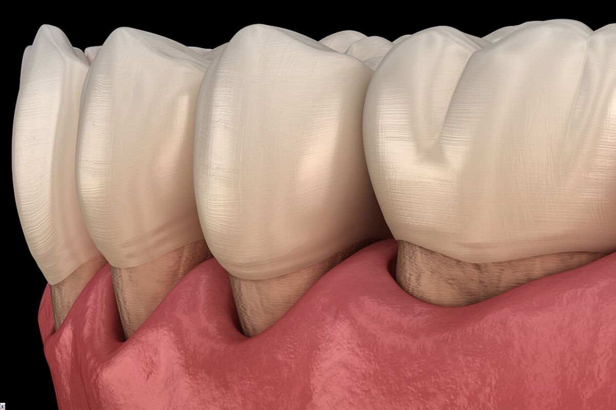 When To Visit a Periodontist for Gum Recession?