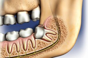 Why Do Wisdom Teeth Need to Be Removed?