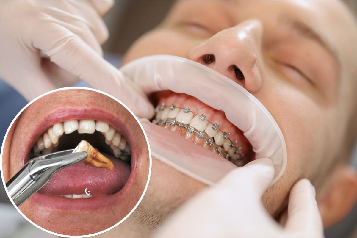 How Long Does It Take To heal From A Tooth Extraction