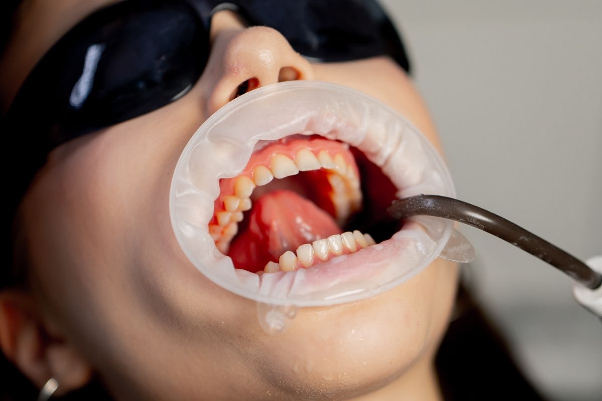 How Does A Cosmetic Dentist Ensure Natural-Looking Botox Results?
