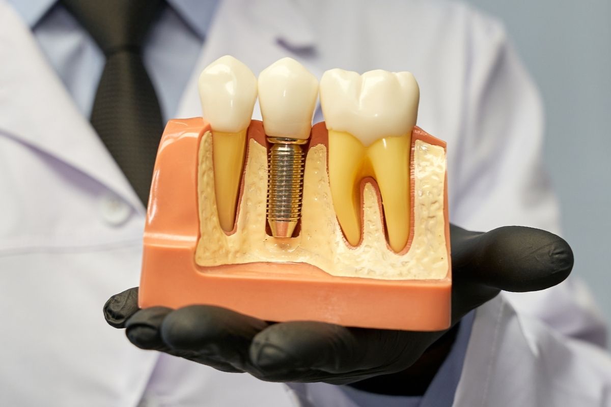 How Painful Are Dental Implants? Procedure & Recovery Explained