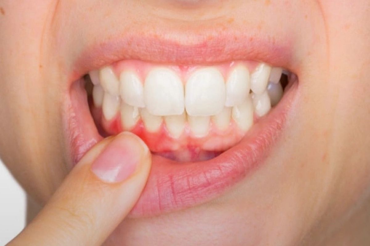 How Does a Periodontist Treat Receding Gums?