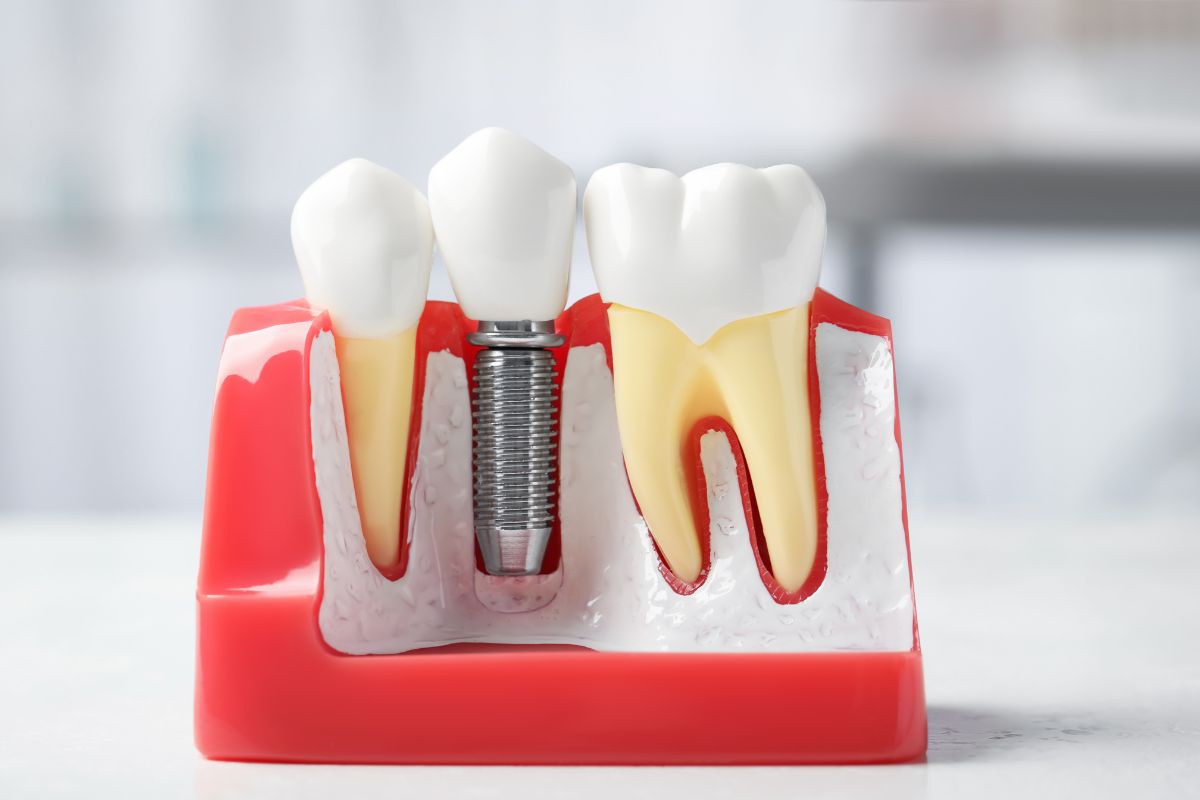How Long Do Dental Implants Last Over Time?