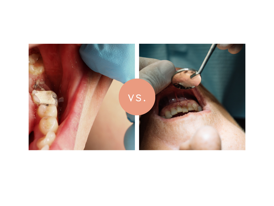 Gingivitis vs. Periodontitis